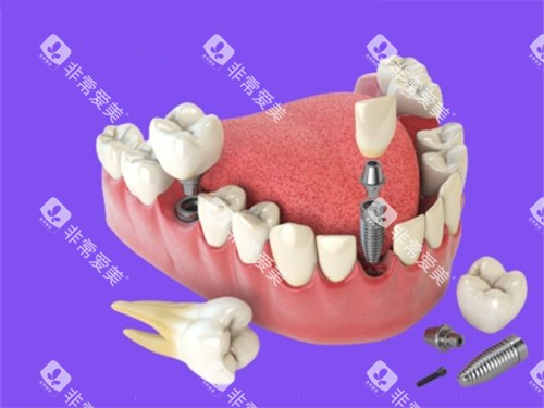 多颗种植牙漫画图