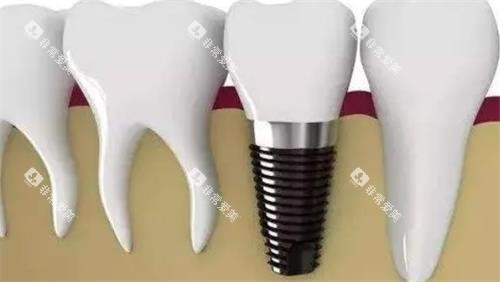 种植牙后效果图