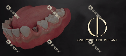 韩一种植牙照片