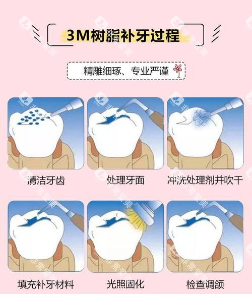 3M树脂补牙方法