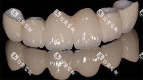 烤瓷牙的颜色和光泽 烤瓷牙的颜色和光泽
