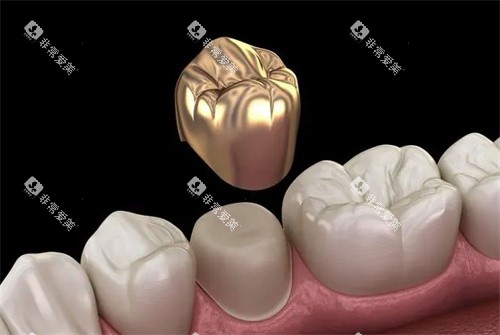 牙冠的材质