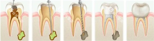 根管治疗步骤图 根管治疗步骤图