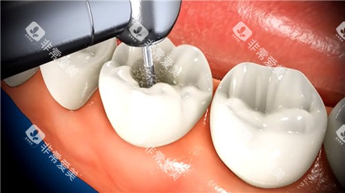 打磨牙齿 打磨牙齿