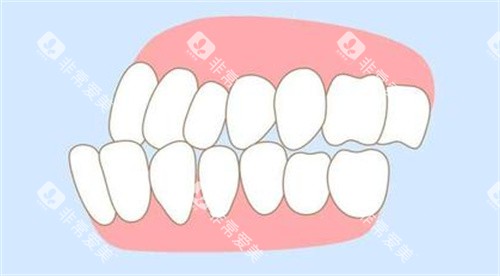 牙齿错颌畸形照片