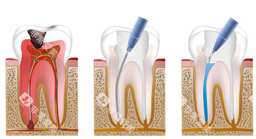 根管治疗流程图 根管治疗流程图