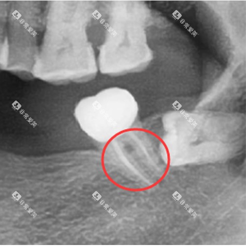 根管治疗后的牙齿 根管治疗后的牙齿