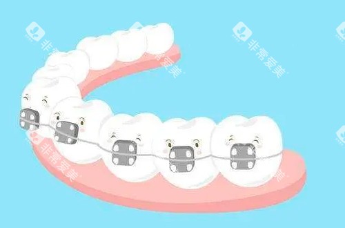 传统牙齿矫正器动画展示图