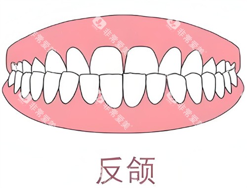 牙齿反颌卡通示意图