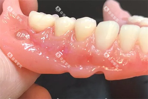 BPS吸附性义齿成品