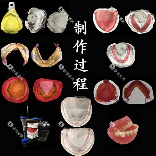 吸附性义齿制作过程示意图