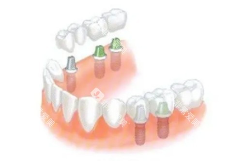 多颗种植牙卡通图片展示