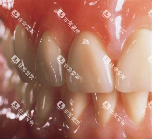 吸附性义齿牙齿细节展示图