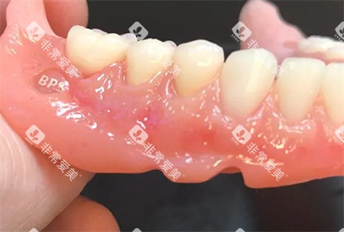 BPS吸附性义齿成品