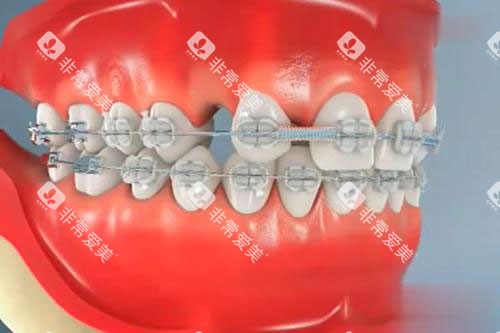 牙齿矫正模型漫画