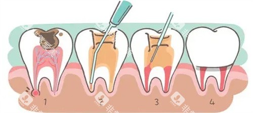 牙周治疗过程图 牙周治疗过程图