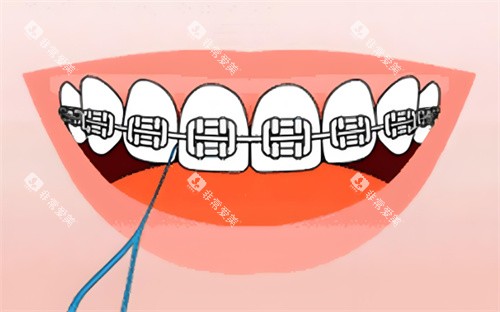 金属牙齿矫正卡通图片 金属牙齿矫正卡通图片