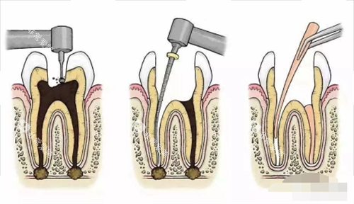 根管治疗过程展示图