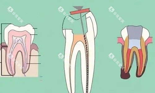 根管治疗的步骤示意