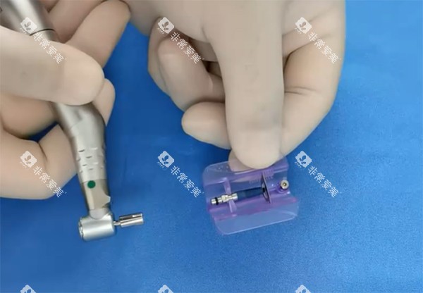 威高WEGO种植牙过程图 威高WEGO种植牙过程图