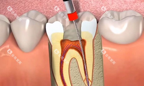 根管治疗中的过程