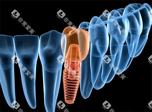 单颗种植牙演示图 单颗种植牙演示图