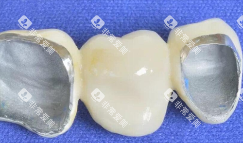 烤瓷牙模型展示图