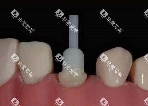 牙齿打桩流程 牙齿打桩流程