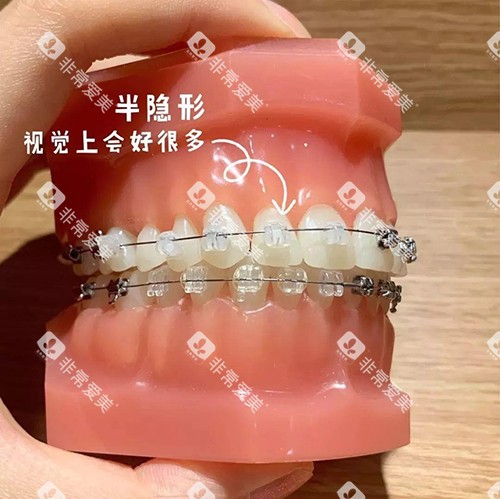 牙齿矫正陶瓷自锁托槽模型