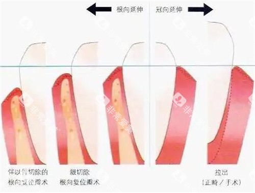 牙冠延长对比展示图