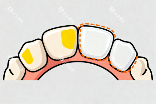 牙齿美白修复卡通图 牙齿美白修复卡通图