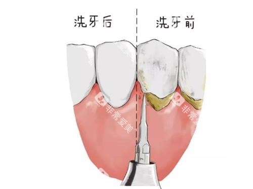 洗牙前后的区别