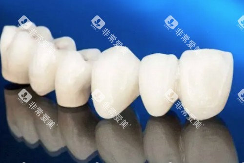 爱尔创全瓷牙模型图