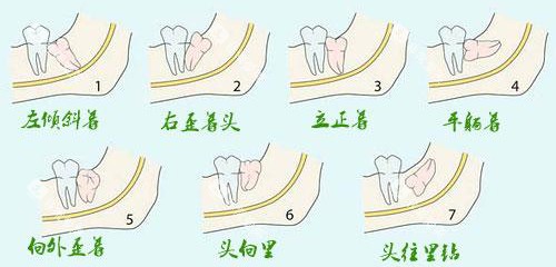 不同类型的智齿示意图 不同类型的智齿示意图