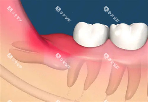 智齿发炎动画图 智齿发炎动画图