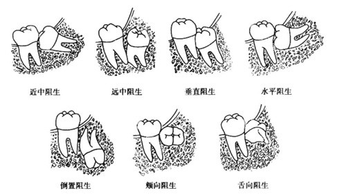智齿各种阻生示意图 智齿各种阻生示意图