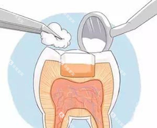 补牙后示意图 补牙后示意图