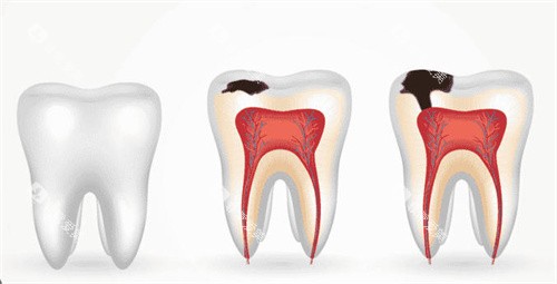 牙釉质龋坏造成蛀牙 牙釉质龋坏造成蛀牙