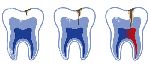 牙釉质牙齿龋坏不同程度 牙釉质牙齿龋坏不同程度