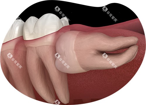 横向智齿 横向智齿