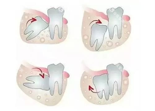 智齿的类型 智齿的类型