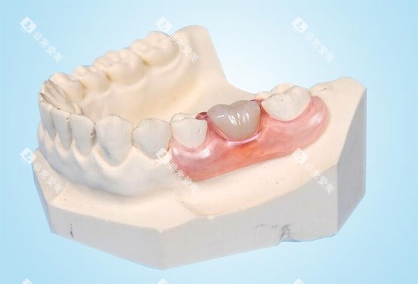 镶牙示意图