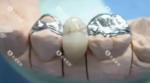 镶牙治疗细节图