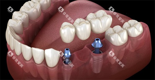 连冠的种植牙 连冠的种植牙