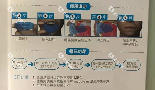 牙齿矫正MRC早期肌功能矫正说明