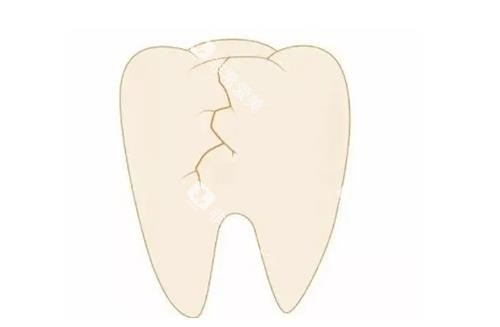 牙齿裂纹卡通示意图
