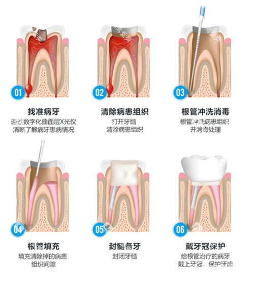 根管治疗流程示意图