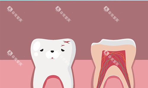根管治疗的流程示意图