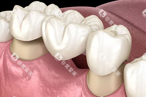 牙冠镶牙示意图 牙冠镶牙示意图