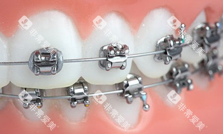 牙齿矫正金属自锁托槽示意图 牙齿矫正金属自锁托槽示意图